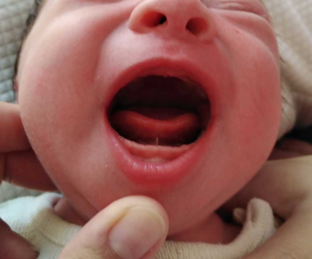 frein de langue restrictif